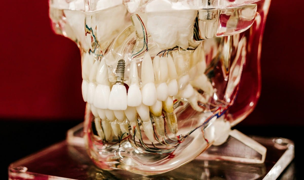 Study finds that dental implants continue to function after 40 years